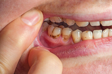 Teeth with plaque close-up. The filling fell off the tooth © Andrii_Abriutin