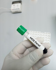 Blood sample for Myelodysplastic syndrome test. To diagnose MDS – a full blood count and a bone...