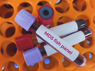 Blood sample for Myelodysplastic syndrome test. To diagnose MDS – a full blood count and a bone...