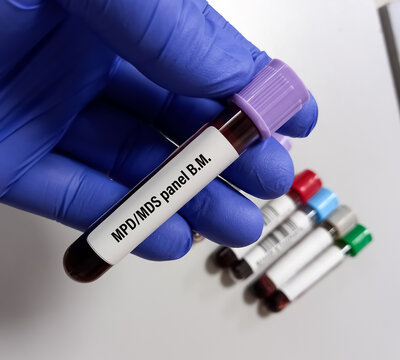 Blood sample for Myelodysplastic syndrome test. To diagnose MDS &ndash; a full blood count and a bone marrow biopsy.