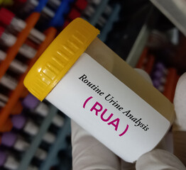 Urine sample for RUA (Routine Urine Analysis) test. Urine RE test. urinalysis.