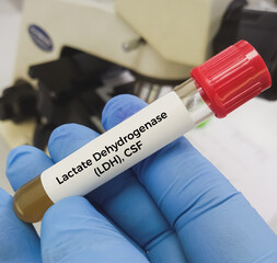 CSF sample for LDH (lactate dehydrogenase) test.