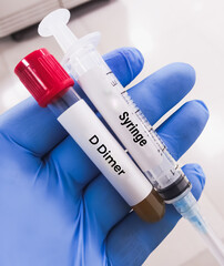 D-Dimer test. Corona patient monitoring test in ICU. Doctor or scientist hold a blood sample for...