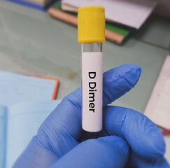 D-Dimer test. Corona patient monitoring test in ICU. Doctor or scientist hold a blood sample for test. close view.deep venous thrombosis. disseminated intra vascular coagulation. aortic dissection.