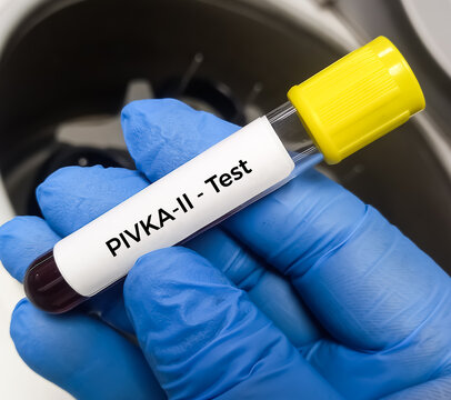 Blood sample for Des-gamma-carboxy prothrombin (DCP) test, to help evaluate whether treatment for one type of liver cancer, hepatocellular carcinoma (HCC).