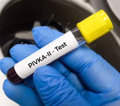 Blood sample for Des-gamma-carboxy prothrombin (DCP) test, to help evaluate whether treatment for one type of liver cancer, hepatocellular carcinoma (HCC).