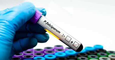 Blood sample of malaria patient positive tested for plasmodium falciparum.