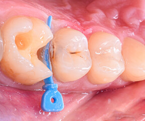 tooth decay and cavity before treatment picture