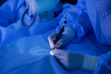 Doctor use equipment for corneal flap formation, patient under sterile cover. Process laser vision...