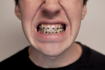 real teeth detail with metal brackets