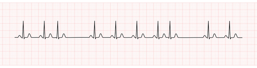 EKG Monitor Showing  Sinus Rhythm with PAC - obrazy, fototapety, plakaty
