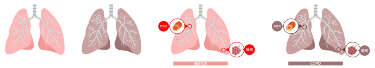 肺の生活習慣病セット※Affinity Designer作成svgファイル	
 - obrazy, fototapety, plakaty