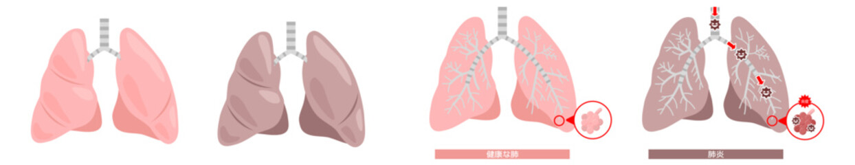 肺の肺炎イラストセット※Affinity Designer作成svgファイル	

