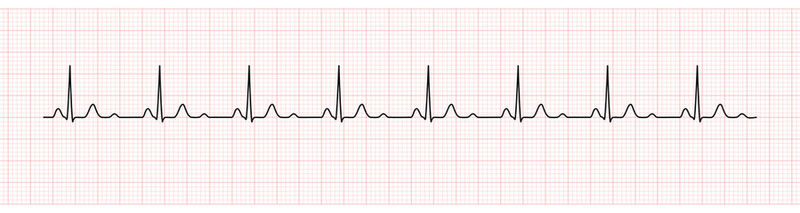 EKG Monitor Showing  Sinus Rhythm with U wave represented Hypokalemia