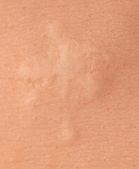 Scar on human skin after heart surgery