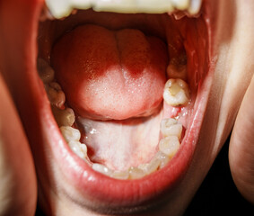 Woman after tooth extraction, medicine concept