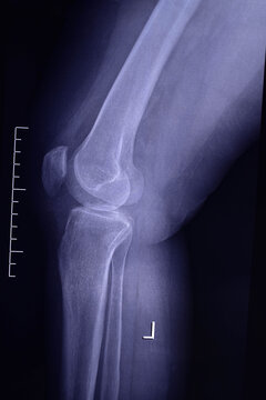 Arthrosis of the knee joint. X-ray image.