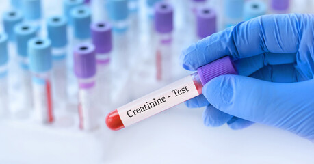 Doctor holding a test blood sample tube with Creatinine test on the background of medical test...