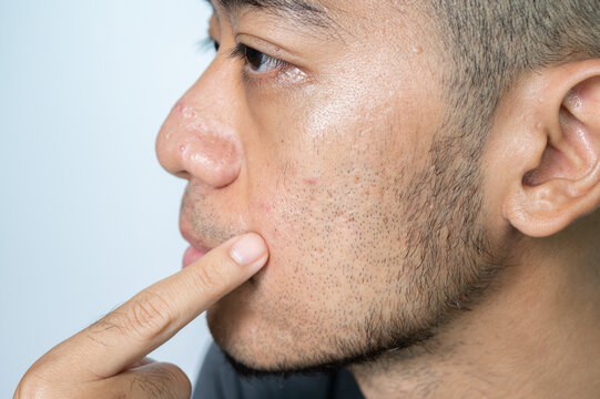 Cropped shot view of Asian man pointing to acne and facial hair occur on his face.