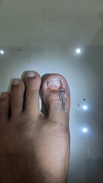Pain on toe because open wound for medic