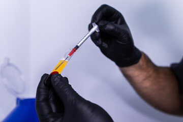 Close-up photo of a doctor's hands extracting platelet-rich plasma from a tube of blood after centrifugation. PRP therapy - obrazy, fototapety, plakaty