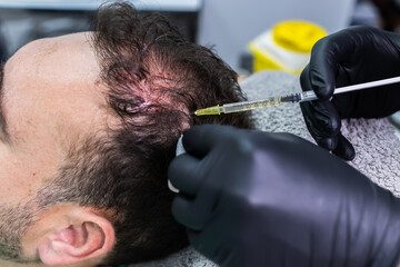 Cosmetologist does PRP therapy against hair loss. She is injecting platelet rich plasma into the head. PRP therapy