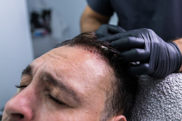 Close-up photo of a patient's scalp with blood dots after a PRP treatment for hair loss.