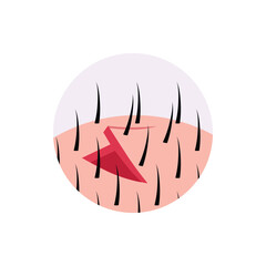 Hair transplantation, vector on white background, medical design icon