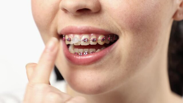 Close up of young Caucasian woman with brackets on teeth shows little box with orthodontic wax and sticks wax on tooth. Concept of dental care during orthodontic treatment