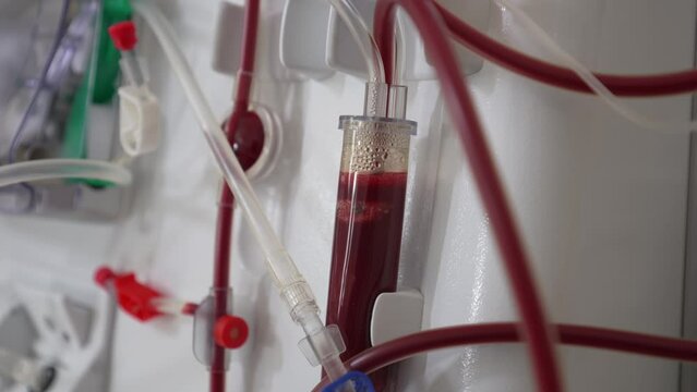 Hemodialysis bloodline tubes connected to hemodialysis machine. Health care, blood purification, kidney failure, transplantation. Part of a dialysis equipment during process of blood filtration.