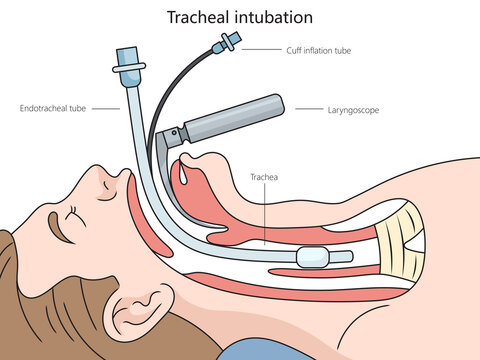 Tracheal intubation structure diagram hand drawn schematic raster illustration. Medical science educational illustration