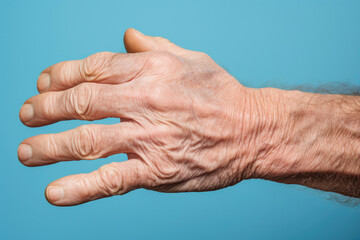 The rough and swollen hand of a senior male, depicting the challenges of geriatric health and the concept of elderly care.