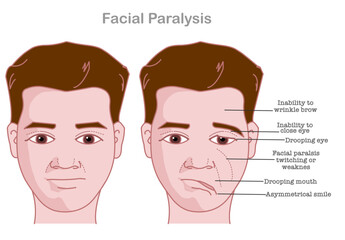 Facial paralysis. Bell palsy. Drooping eyes. twitching weakness causes. asymmetric face, smile. Medical illustration vector - obrazy, fototapety, plakaty