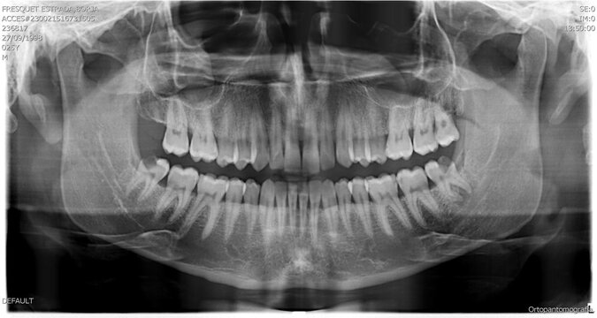HUMAN PATHOLOGICAL AND ANATOMICAL RADIOGRAPHY (Cavities)