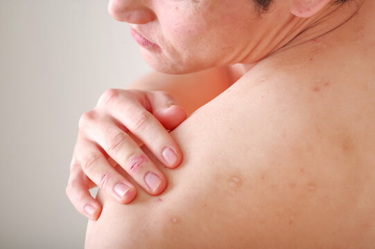 背中のアトピーを気にする男性