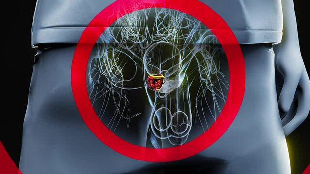 4K abstract 3D animation of the prostate cancer