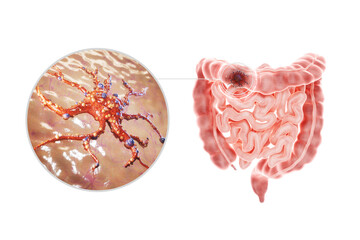 Intestinal cancer, tumor, human anatomy. Concept health care, disease, medicine, biology, chemotherapy. 3D rendering, 3D illustration, copy space, photorealism.