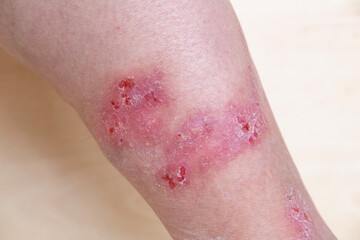 rash, hives, itchy skin on legs, inflammation and allergy, disease on body of female patient, Dermatology and Skin Issues, health care concept - obrazy, fototapety, plakaty