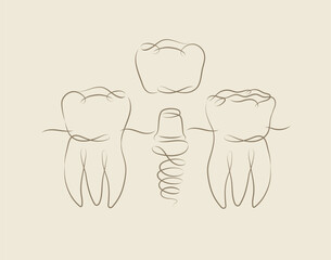 Teeth implant illustration drawing in linear style on beige background