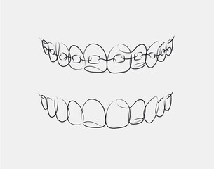 Jaws with and without braces installed drawing in linear style on white background
