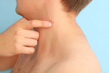 Young man pointing at moles on his neck against blue background, closeup - obrazy, fototapety, plakaty
