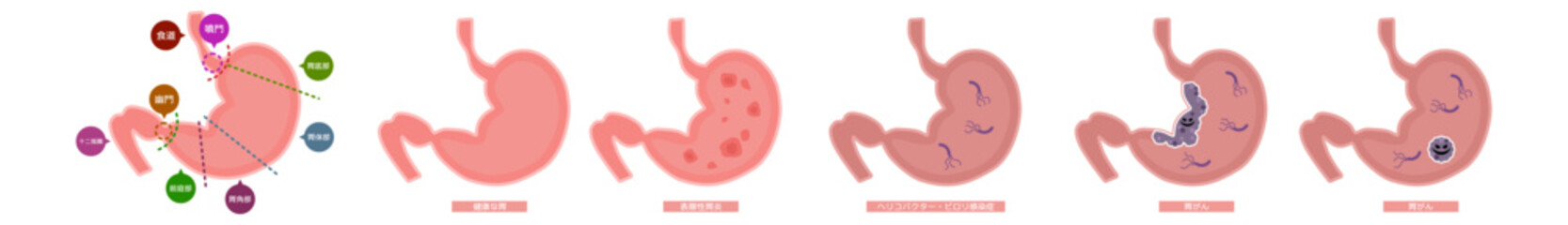 胃袋　胃炎胃がんセット※Affinity Designer作成svgファイル