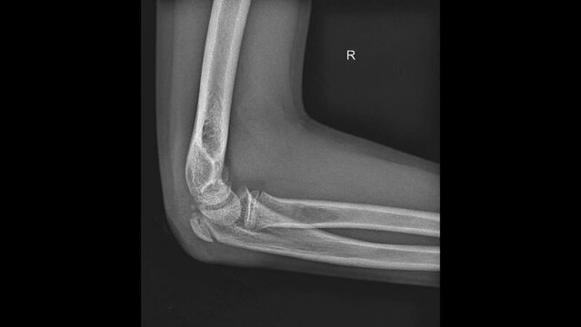 Orthopedic X-ray highlighting elbow bones fracture and articulations.