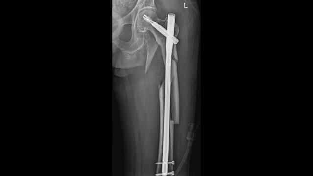 femur Fracture with Intramedullary Nail
