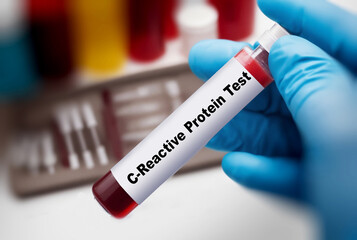Obraz premium Test tube with blood sample for CRP C-reactive protein test to recognize viral or bacterial infection
