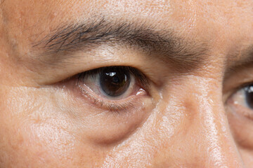 Eyelid spasm is abnormal contraction of the eyelid muscles.