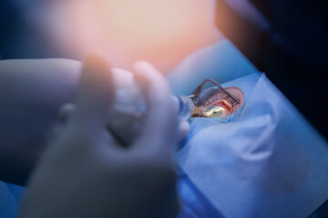 Doctor use equipment for corneal flap formation, patient under sterile cover. Process laser vision...