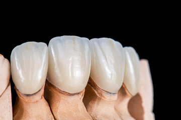 emax crowns and veneers