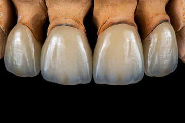 emax crowns and veneers