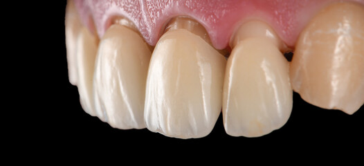 emax crowns and veneers